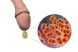 男性器の先から膿が漏れ出る