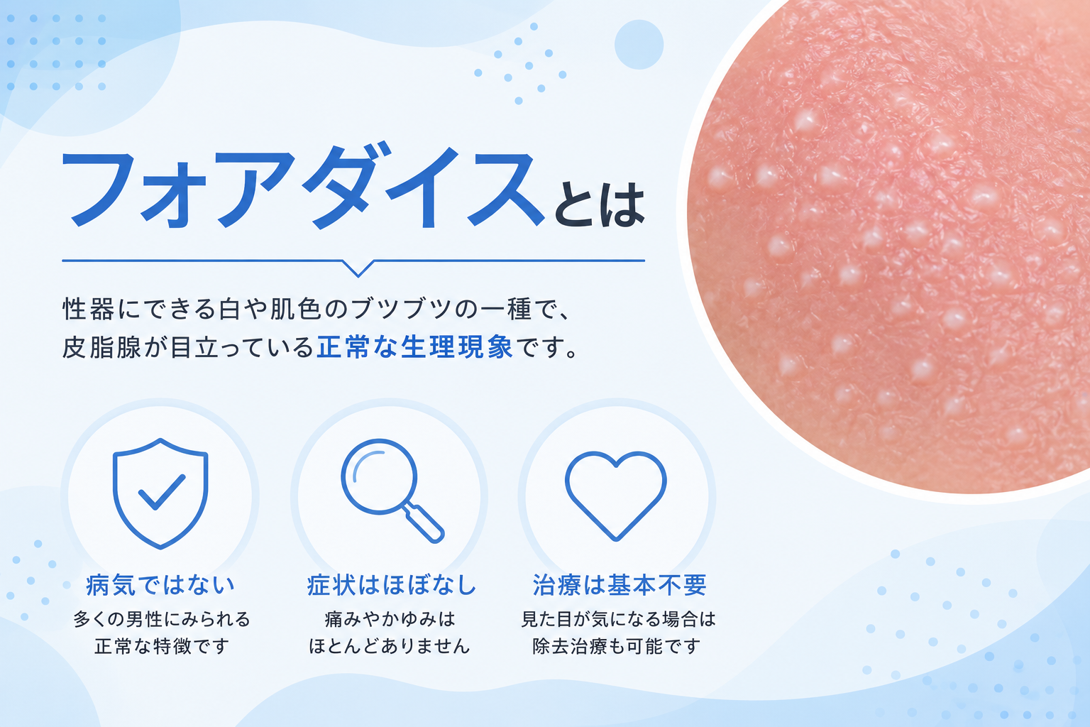 フォアダイスとは