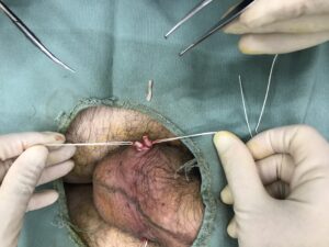 パイプカット・Vasectomy