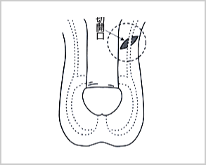 パイプカット流れ