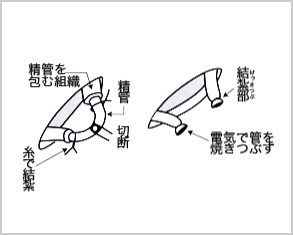 パイプカット流れ
