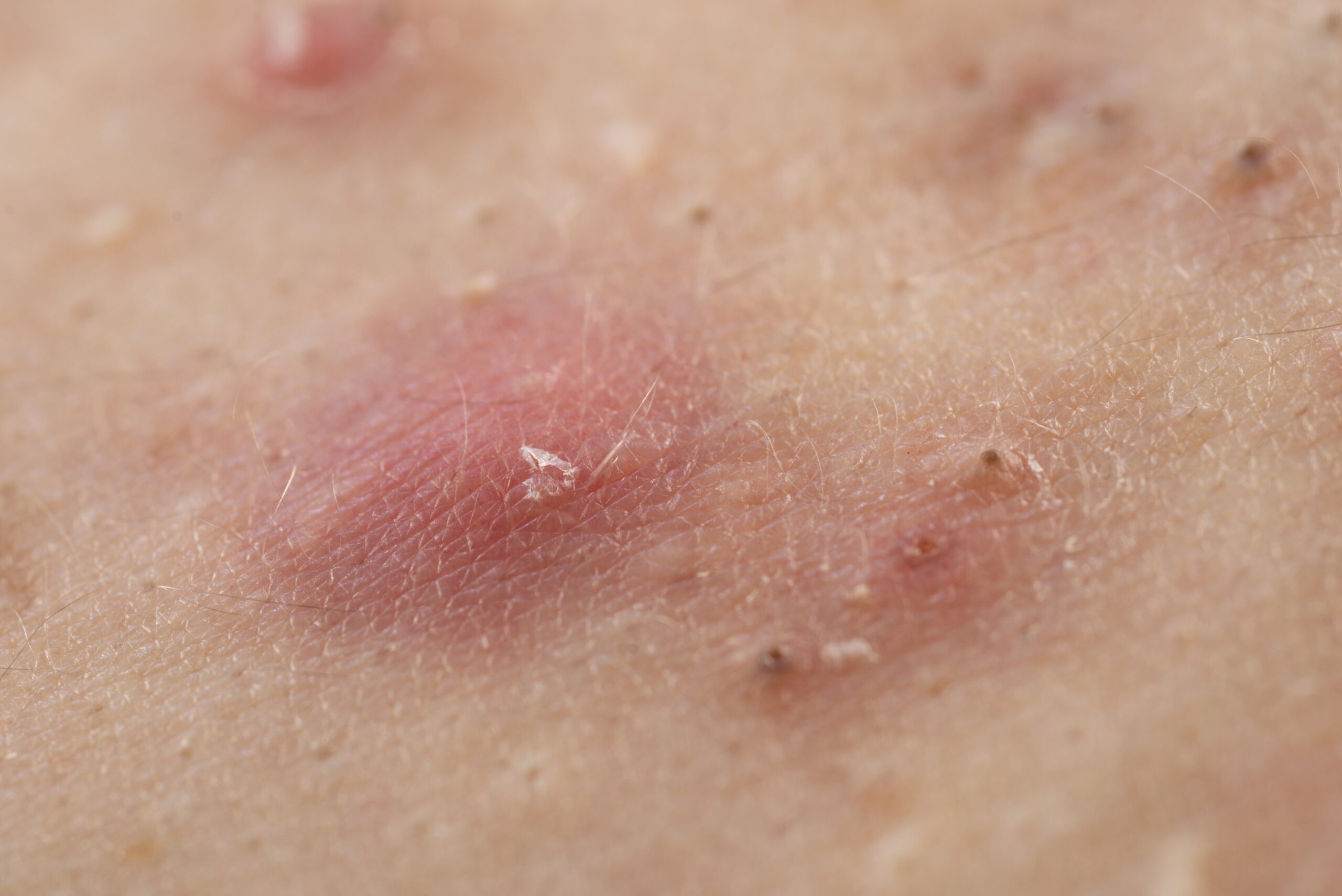 皮膚が炎症を起こしている様子