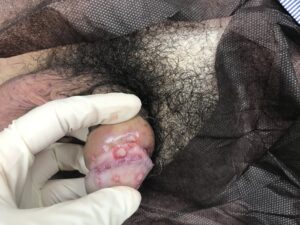 ヘルペス、コンジローマ、包茎